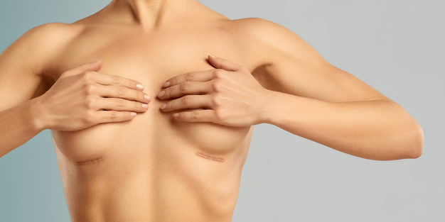Tipos de mamoplastia: você sabe quais são?