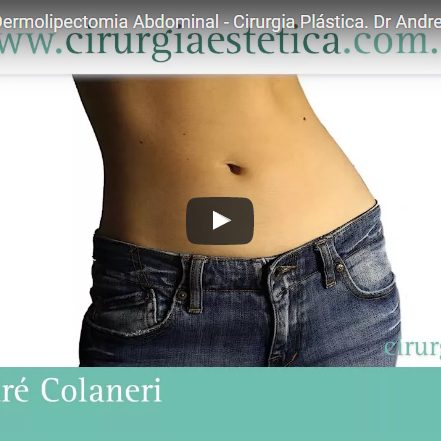 Abdominoplastia - Dermolipectomia Abdominal - Cirurgia Plástica
