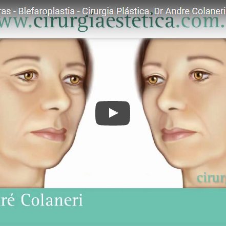 Cirurgia das Pálpebras - Blefaroplastia - Cirurgia Plástica