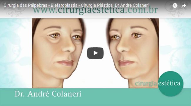 Cirurgia das Pálpebras - Blefaroplastia - Cirurgia Plástica