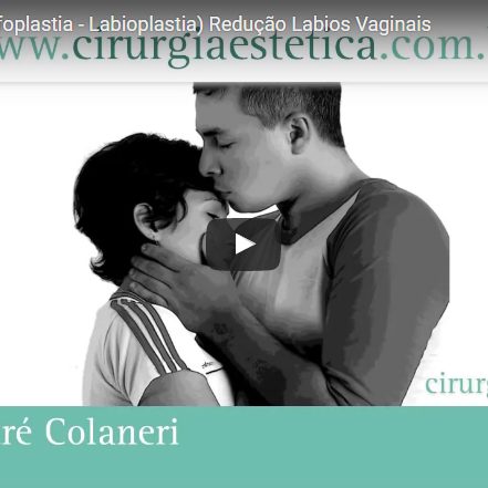 Cirurgia Intima (Ninfoplastia – Labioplastia) Redução Labios Vaginais