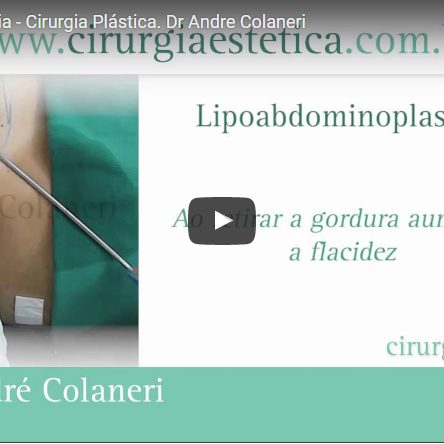 Lipo-abdominoplastia – Cirurgia Plástica