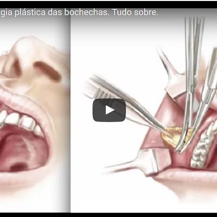 Bichectomia, a cirurgia plástica das bochechas. Tudo sobre.