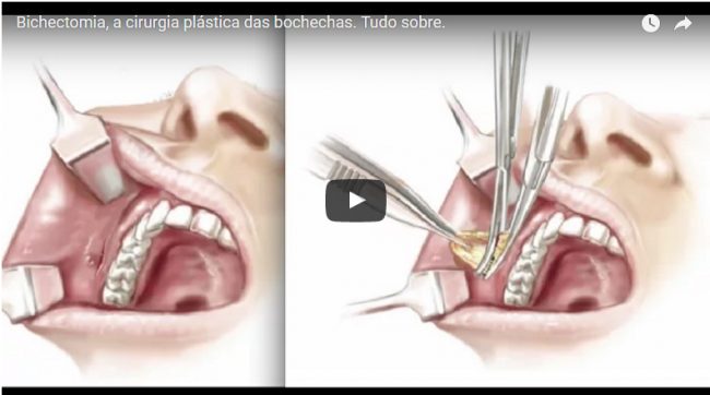 Bichectomia, a cirurgia plástica das bochechas. Tudo sobre.