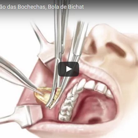 Bichectomia, Redução das Bochechas, Bola de Bichat