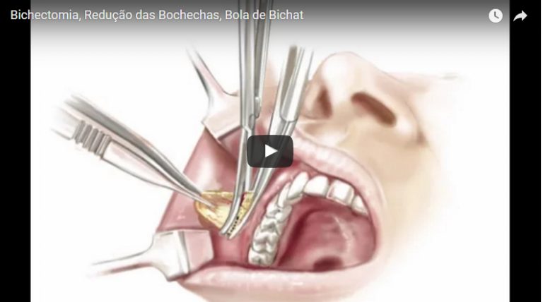 Bichectomia, Redução das Bochechas, Bola de Bichat