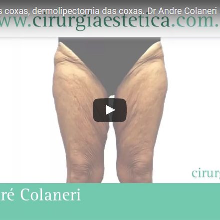 Cirurgia plástica das coxas, dermolipectomia das coxas