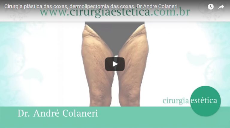 Cirurgia plástica das coxas, dermolipectomia das coxas