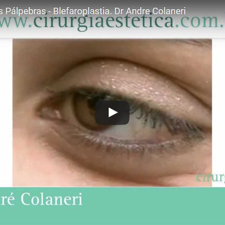 Cirurgia Plástica das Pálpebras – Blefaroplastia