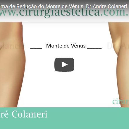 Cirurgia Plástica Íntima de Redução do Monte de Vênus
