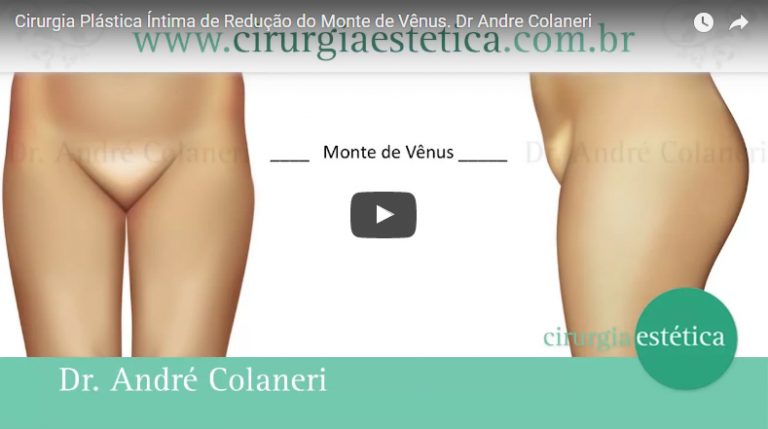 Cirurgia Plástica Íntima de Redução do Monte de Vênus