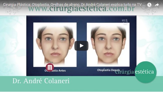 Cirurgia Plástica: Otoplastia, Orelhas de abano