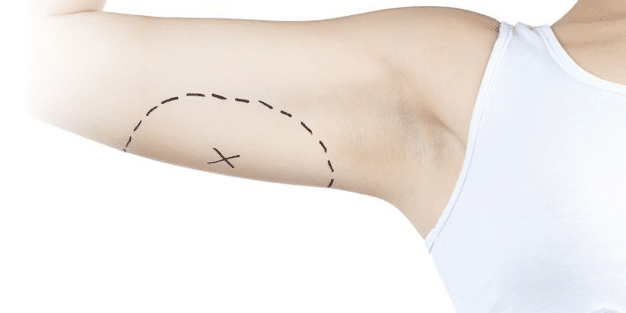dermolipectomia-braquial