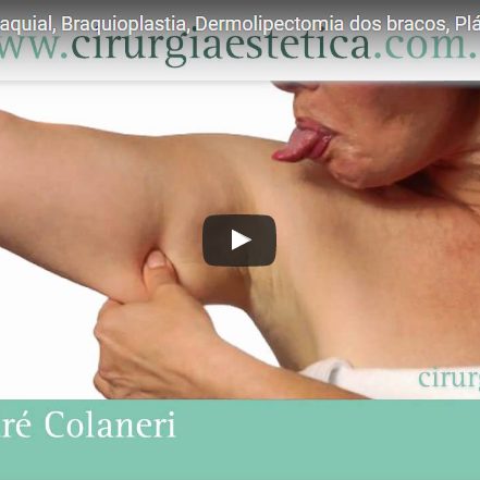 Dermolipectomia Braquial, Braquioplastia, Plástica dos braços