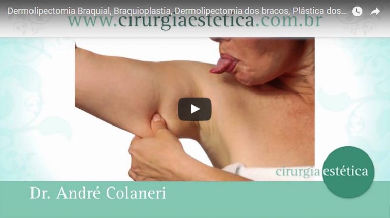 Dermolipectomia Braquial, Braquioplastia, Plástica dos braços