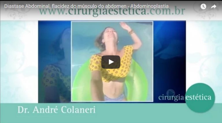 Diastase Abdominal, flacidez do músculo do abdômen – Abdominoplastia