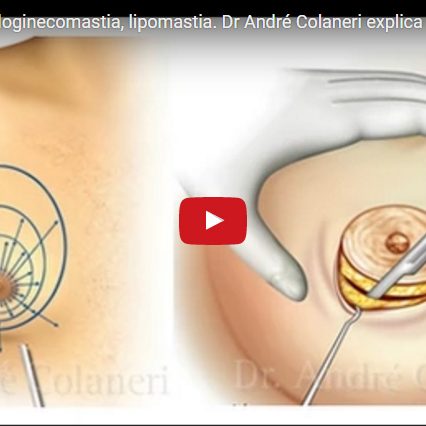 Ginecomastia, pseudoginecomastia, lipomastia. Dr André Colaneri explica detalhes