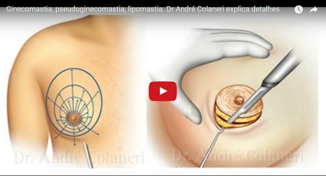 Ginecomastia, pseudoginecomastia, lipomastia. Dr André Colaneri explica detalhes