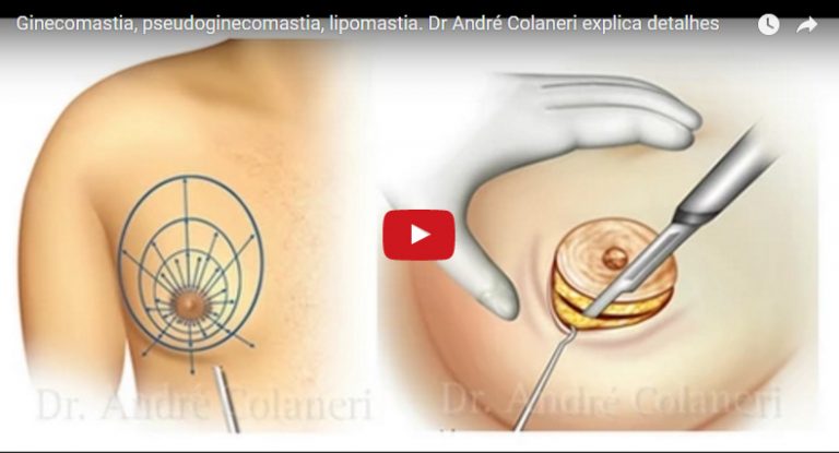 Ginecomastia, pseudoginecomastia, lipomastia. Dr André Colaneri explica detalhes