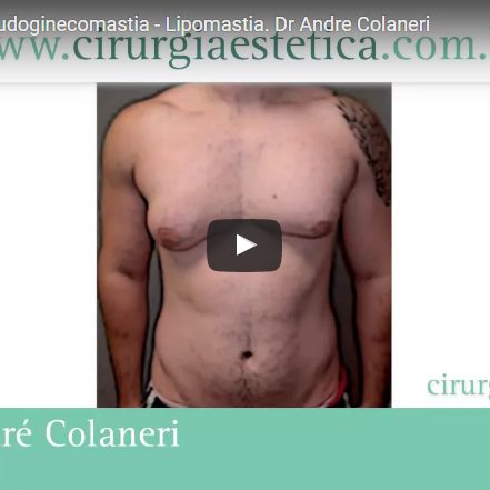 Ginecomastia – Pseudoginecomastia – Lipomastia