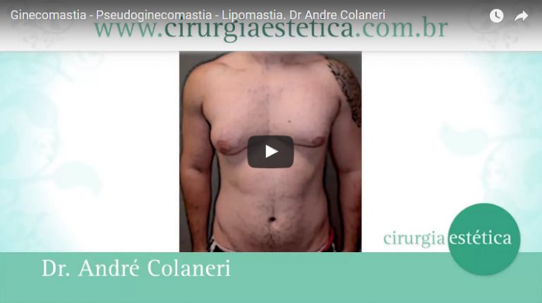 Ginecomastia – Pseudoginecomastia – Lipomastia