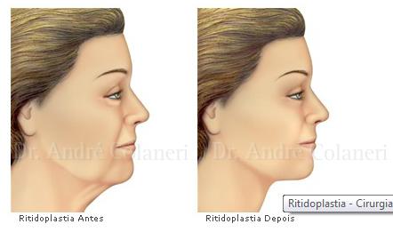 Ilustrações Ritidoplastia ou Lifting Facial (cirurgia da face)