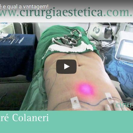 Lipo a Laser, como é e qual a vantagem!