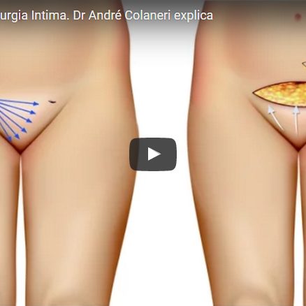 Monte de Vênus, Cirurgia Intima