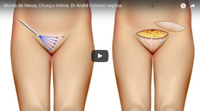 Monte de Vênus, Cirurgia Intima