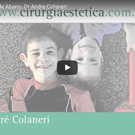 Otoplastia – Orelha de Abano