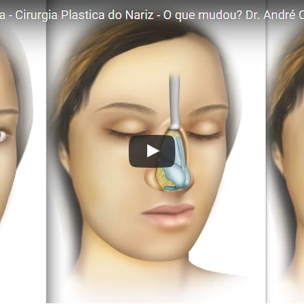 Rinoplastia moderna – Cirurgia Plastica do Nariz – O que mudou?