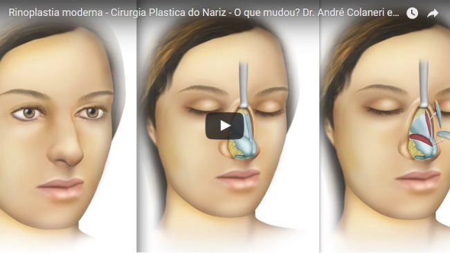 Rinoplastia moderna – Cirurgia Plastica do Nariz – O que mudou?