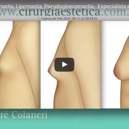 Tudo sobre Ginecomastia, Lipomastia, Pseudoginecomastia – Especialista explica!