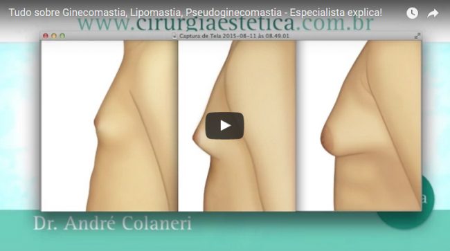 Tudo sobre Ginecomastia, Lipomastia, Pseudoginecomastia – Especialista explica!