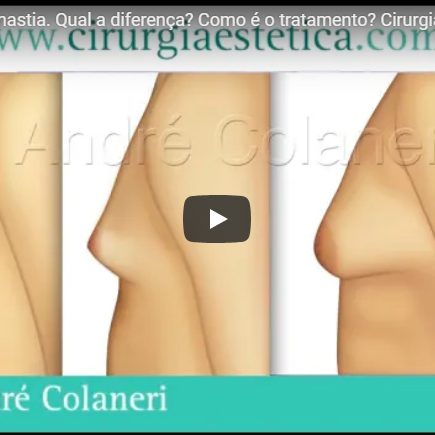 Ginecomastia, Lipomastia. Qual a diferença? Como é o tratamento? Cirurgia?