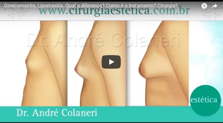 Ginecomastia, Lipomastia. Qual a diferença? Como é o tratamento? Cirurgia?