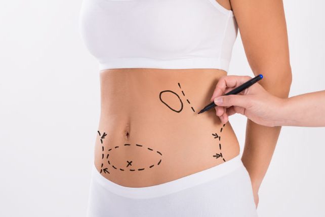 lipoabdominoplastia 6