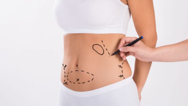 lipoabdominoplastia