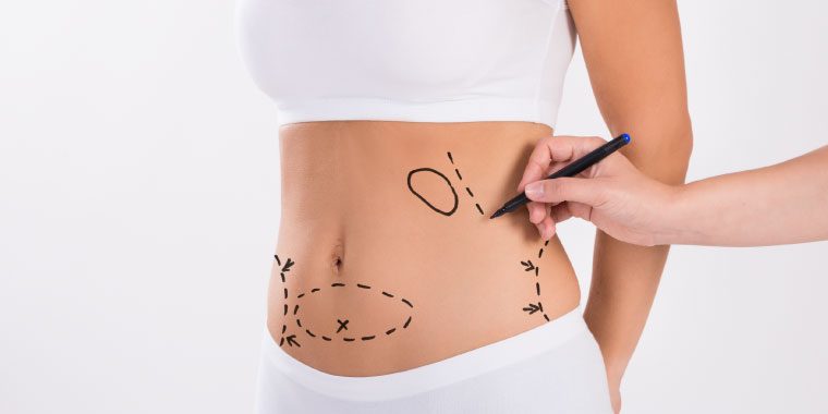 lipoabdominoplastia