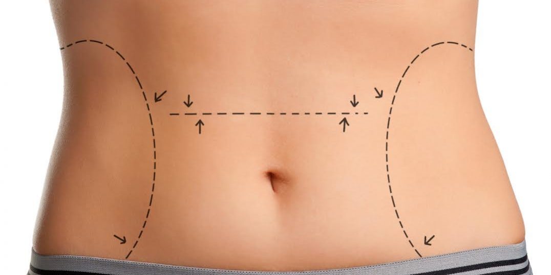 lipoaspiracao-verdades-1