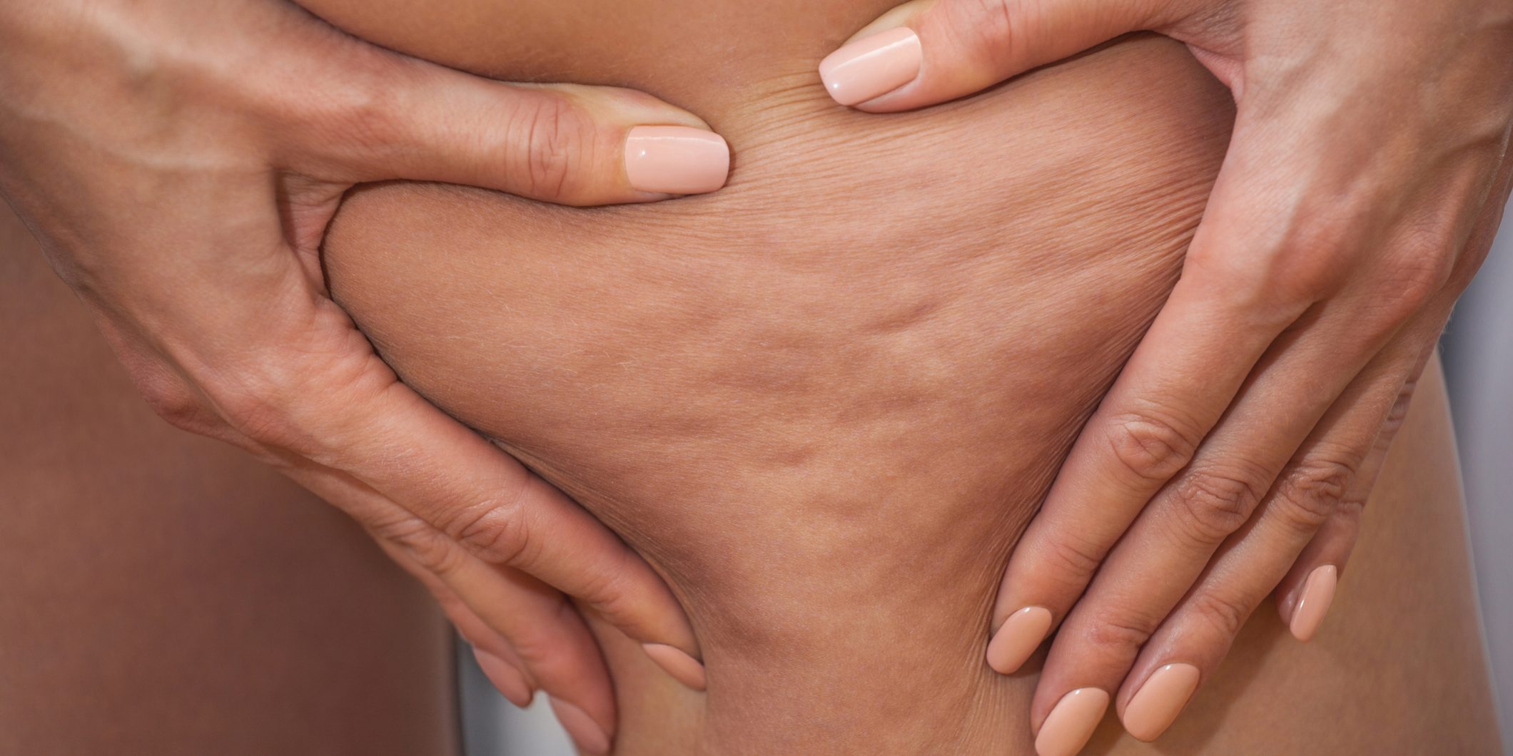 como-tratar-a-celulite