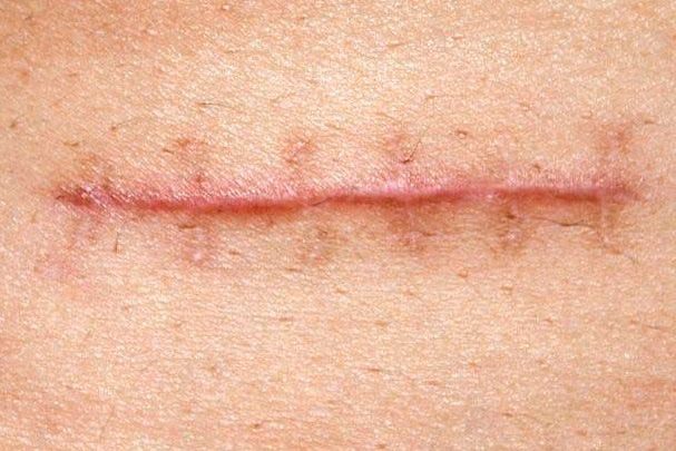 entenda-o-que-e-cicatriz-hipertrofica-e-qual-a-diferenca-da-queloide-1