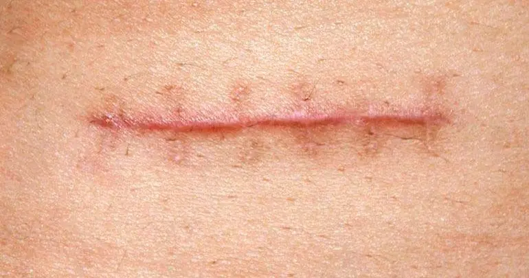 Cicatriz hipertrófica e queloide: entenda a diferença!