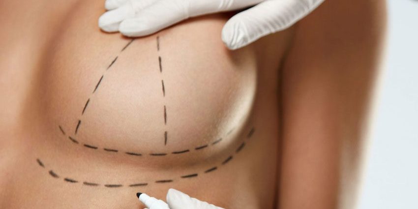 mastopexia mastopexia