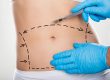 Abdominoplastia (Cirurgia do Abdome) - Como é realizada a cirurgia?