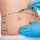 Abdominoplastia (Cirurgia do Abdome) - Como é realizada a cirurgia?