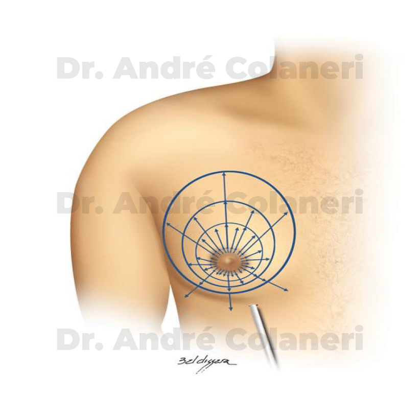 Lipoaspiração das mamas