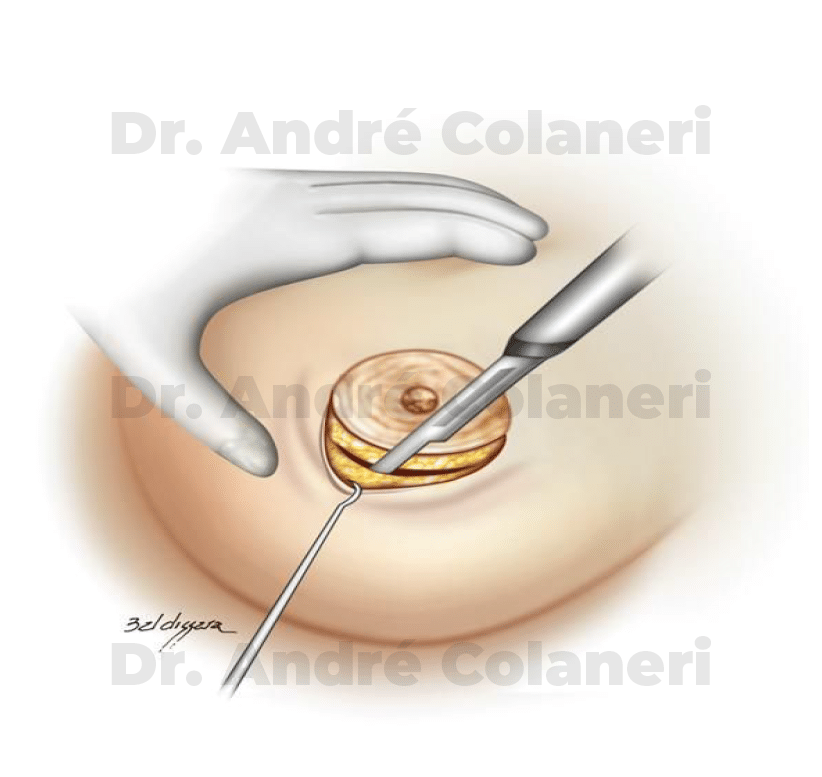 Incisão periareolar inferior