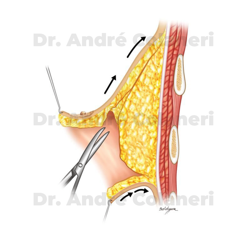 Resseção da glândula