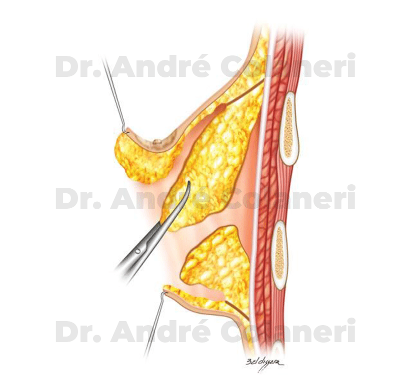 Resseção da glândula